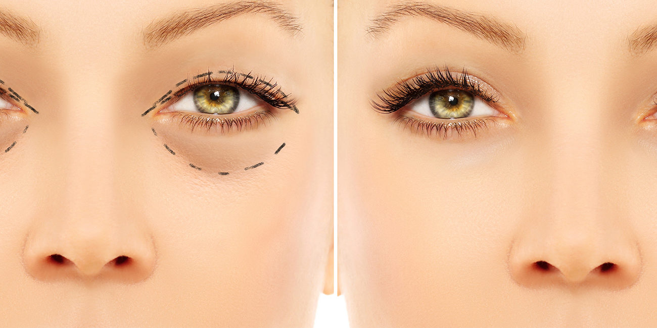 FINANCIACION BLEFAROPLASTIA